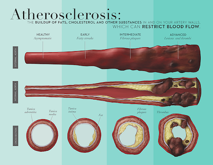 Atherosclerosis