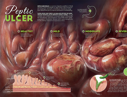 Peptic Ulcer